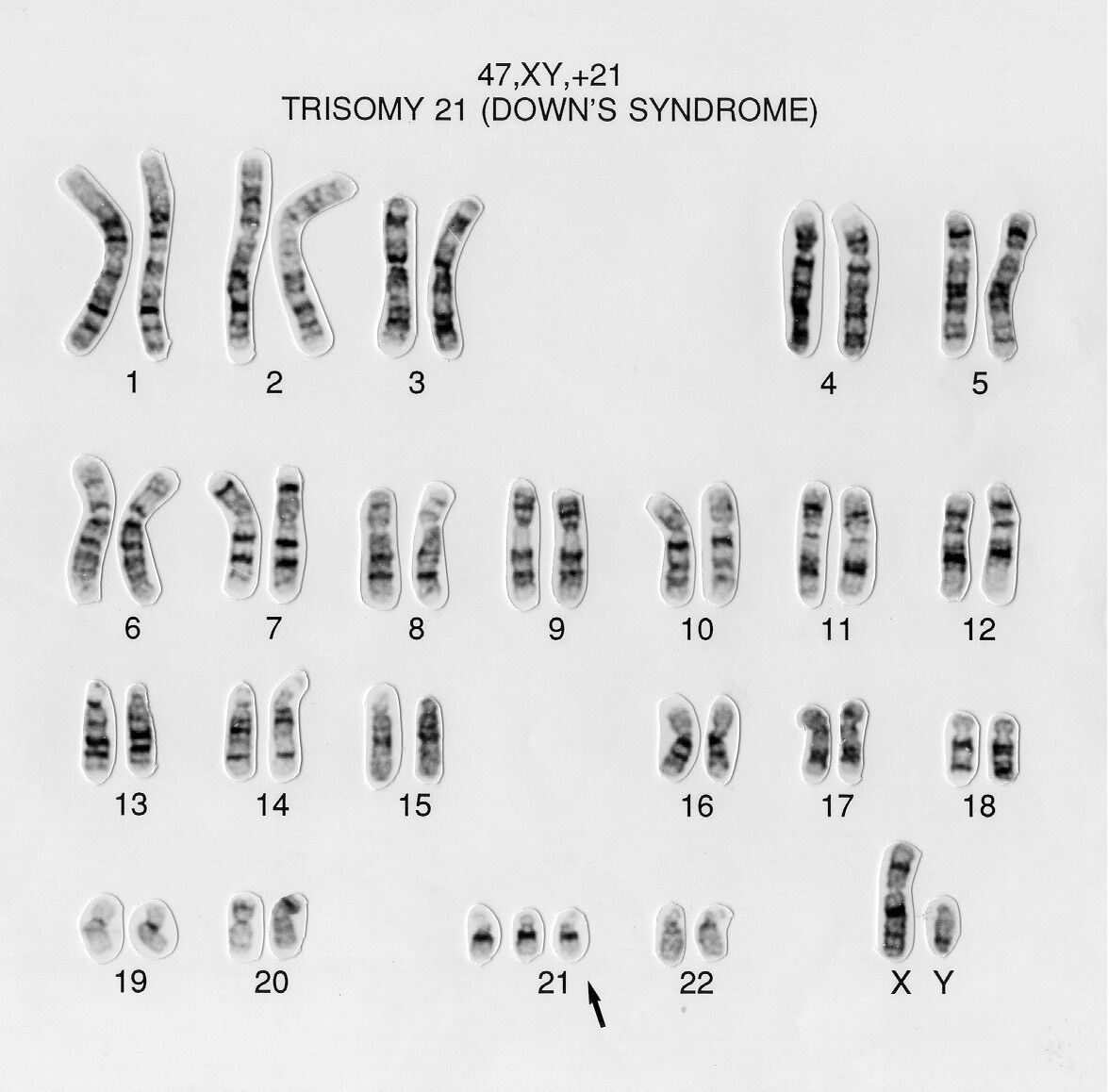 G-banded karyotype arranged into pairs 1&ndash;22 plus X and Y, labeled 47,XY,+21 Trisomy 21 (Down's syndrome). Chromosome 21 has three copies instead of the normal two, marked with an arrow; every other chromosome is present as a normal pair.
